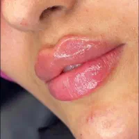 نیازمند کلاینت برای تزریق ژل و بوتاکس