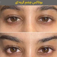 تزریق ژل و بوتاکس|خدمات آرایشگری و زیبایی|دوگنبدان, |دیوار