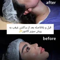 آف 50% ساکشن غبغب سوپر کانتور VLine بدون عمل جراحی|خدمات آرایشگری و زیبایی|مشهد, هفت تیر (آب و برق)|دیوار