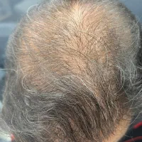 خداحافظی با کم‌پشتی مو شروع یک تغییر جذاب