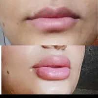 انجام خدمات ژل و بوتاکس