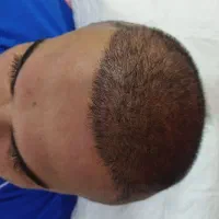کاشت مو با تخفیف ویژه بدون ورم وکبودی|خدمات زیبایی و سلامت|اهواز, زیتون کارمندی|دیوار