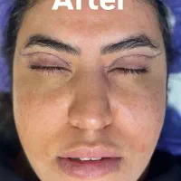 بلفاروپلاستی به روش cat eyes