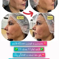 فرصت بسیارویژه لیزر ،هایفوتراپی ،ژل بوتاکس ،منظریه|خدمات آرایشگری و زیبایی|فردیس, منظریه|دیوار