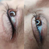 فیبروز .میکرو.شیدینگ.خط چشم