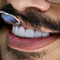 اقساط ویژه ایمپلنت،کامپوزیت،لمینیتلبه شیشه ای