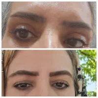 جراحی پلک غبغب کاشت دایرکت