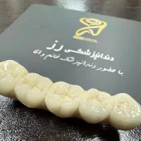 روکش ایمپلنت دندان مصنوعی