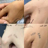 اجاره ورنت لیزر کیوسوییچپیکوشور بااپراتور حرفه ای|پزشکی|تهران, اقدسیه|دیوار