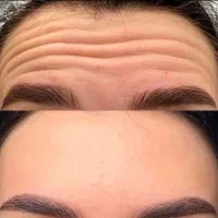 ژل و بوتاکس/ ژل لب/کانتورینگ عربی/روسی|خدمات آرایشگری و زیبایی|فردیس, فردیس|دیوار