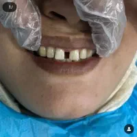 با کامپوزیت لبخندی زیبا داشته باشید