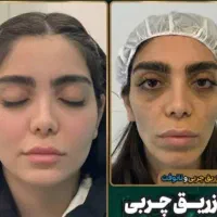 ساکشن چربی وتزریق
