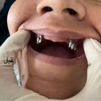 ایمپلنت اقساط‌گارانتی مادام العمر فقط۱۳تومن