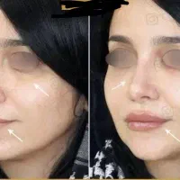 تزریق ژل و بوتاکس.انجام تمامی خدمات آرایشی