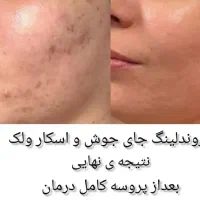 برداشتن خال کک مک منگوله گوشتی لک در یک جلسه ژل|خدمات آرایشگری و زیبایی|گلستان (تهران), |دیوار