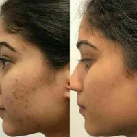 خدمات و آموزش برداشتن انواع خال