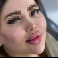 تزریق ژل،بوتاکس درمکانی مستقل بارعایت اصول بهداشتی|خدمات آرایشگری و زیبایی|زاهدان, |دیوار