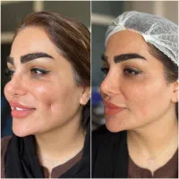 ساکشن شکم ترنسفر تزریق بلفارو اپیکانتوپلاستی|خدمات آرایشگری و زیبایی|مشهد, هفت تیر (حافظ)|دیوار