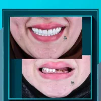 مرکز تخصصی ایمپلنت دندانپزشکی شیراز / تعرفه دولتی|خدمات زیبایی و سلامت|شیراز, ملاصدرا|دیوار
