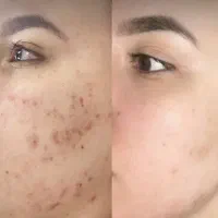 کلینیک تخصصی درمان آکنه ( جوش ) عفیف اباد|خدمات آرایشگری و زیبایی|شیراز, عفیف‌آباد|دیوار