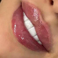 جشنواره تزریق فیلر مدت محدود فقط ۷۸۰ تومن|خدمات آرایشگری و زیبایی|زنجان, |دیوار