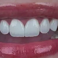 انجام کامپوزیت با تعرفه دولتی در مطب خصوصی