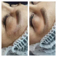 رفع تیرگی بدن حذف تتو صورت و بدن. کربن تراپی|خدمات آرایشگری و زیبایی|تربت‌حیدریه, کاشانی|دیوار