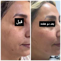 درمان لک جای جوش منافذ باز
