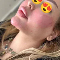 ترریق چربی وژل با۵سال سابقه کاری