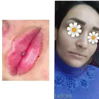 جشنواره ژل و بوتاکس|خدمات آرایشگری و زیبایی|تهران, هفت حوض|دیوار