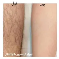خدمات اپیلاسیون تخصصی و آموزش