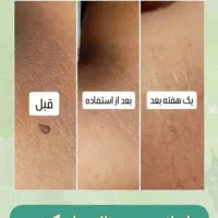 درمان خانگی زگیل و تبخال تناسلی|آرایشی، بهداشتی، درمانی|اصفهان, شهرک زاینده رود|دیوار