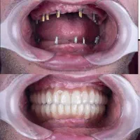 ایمپلنت تخصصی در ارومیه