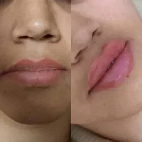 مدل ژل و بوتاکس|خدمات آرایشگری و زیبایی|قم, باسکول|دیوار