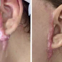 درمان گوشت اضافه  بر اثر سوختگی وچاقو، غیره