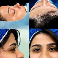 جراحی بینی در تهران با آف ۵۰درصد،جشنواره آذر|خدمات آرایشگری و زیبایی|پاکدشت, پاکدشت (مامازند)|دیوار