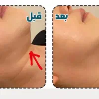 کلینیک لاغری آنیلا،بادستگاه کویتیشن آراف