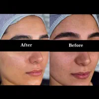 تخفیف تابستانه خدمات پوست