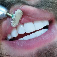 کامپوزیت دندان|خدمات آرایشگری و زیبایی|زنجان, |دیوار