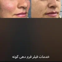 ژل/بوتاکس /فیلر بادی /|خدمات آرایشگری و زیبایی|شیراز, ستارخان|دیوار