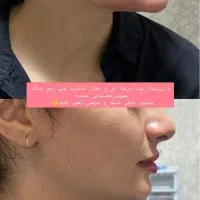 ژل وبوتاکس فیلرمزوپی ارپی آنزیم هایفوبلفاروپلاستی|خدمات آرایشگری و زیبایی|تبریز, |دیوار