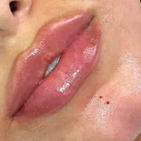 ژل لب تزریق ژل بوتاکس ژل گونه چانه زاویه فک|خدمات آرایشگری و زیبایی|اصفهان, سعادت‌آباد|دیوار
