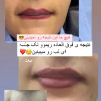 ریموو،پاک کردن تتوی صورت|خدمات آرایشگری و زیبایی|دوگنبدان, |دیوار