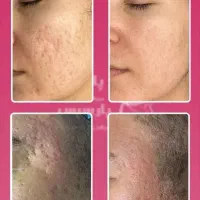 جشنواره یلدایی کاشت مو ، ابرو و مزوتراپی و prp|خدمات آرایشگری و زیبایی|زنجان, |دیوار