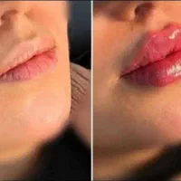 خدمات تزریق ژل و بوتاکس با سابقه بالا تضمینی