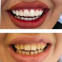 ایمپلنت اقساطی با طرح وام دندانپزشکی متخصص فک صورت