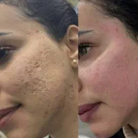 تخفیف ویژه حذف اسکار،منافذوتیرگی ها باco2+با مزو