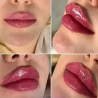 خدمات زیبایی تزریق بوتاکس و فیلر prp مزوژل|استخدام درمانی، زیبایی، بهداشتی|کرمانشاه, |دیوار