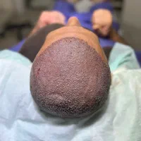 کاشت مو، ریش، ابرو|خدمات آرایشگری و زیبایی|تهران, الهیه|دیوار