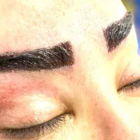 کاشت مو، ابرو، ریش، سبیل، شقیقه